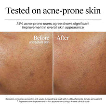Neutrogena Hydro Boost tested on acne-prone skin before-and-after results chart
