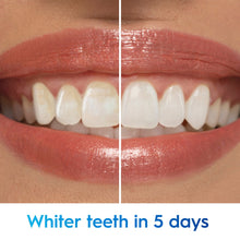 Split view of teeth whitening results with brightened smile