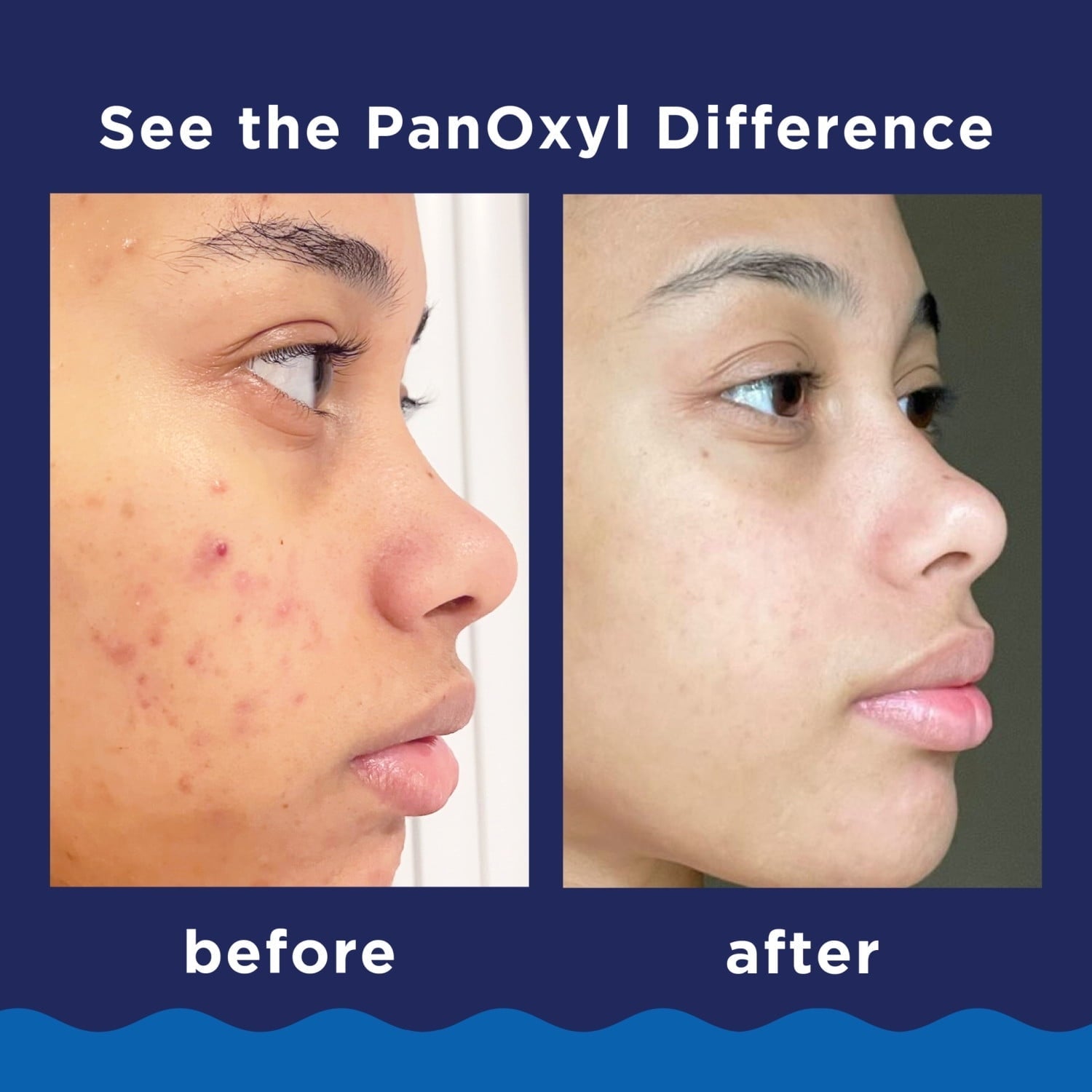 PanOxyl 10% Benzoyl Peroxide Acne Foaming Wash, Clear Acne, 5.5 Oz