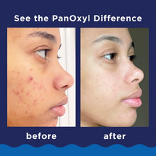 Acne wash before-and-after face portraits with visible smoother skin