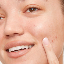 Acne dot patch on a woman’s cheek, close-up