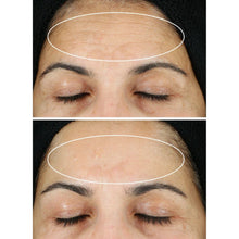 StriVectin retinol serum under-eye treatment on face, eye area outlined